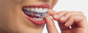 Appareil dentaire pour adulte : comment choisir le traitement le plus adapté à votre sourire ?